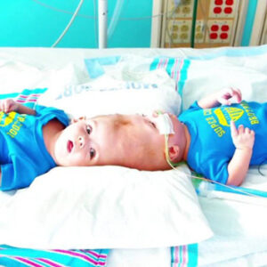 Separan con éxito a dos bebés siameses unidos por la cabeza