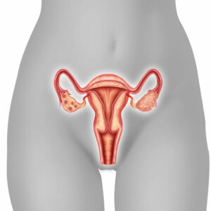 Tengo quistes en los ovarios