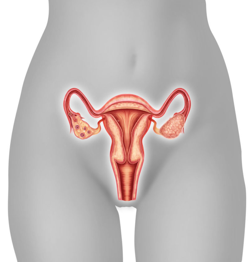 Tengo quistes en los ovarios