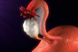 Todo sobre el síndrome de ovarios poliquísticos