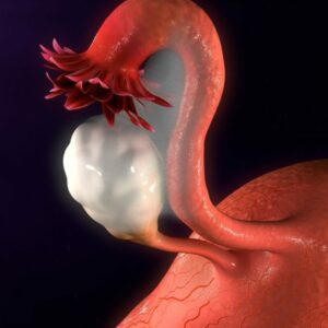 Todo sobre el síndrome de ovarios poliquísticos