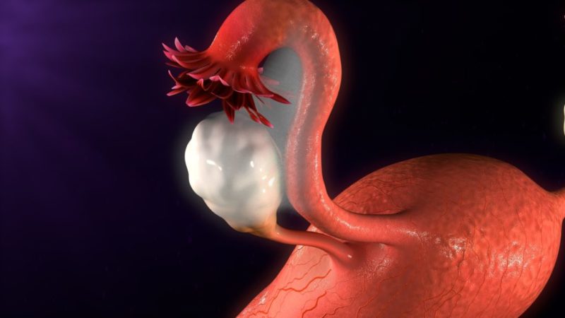 Todo sobre el síndrome de ovarios poliquísticos