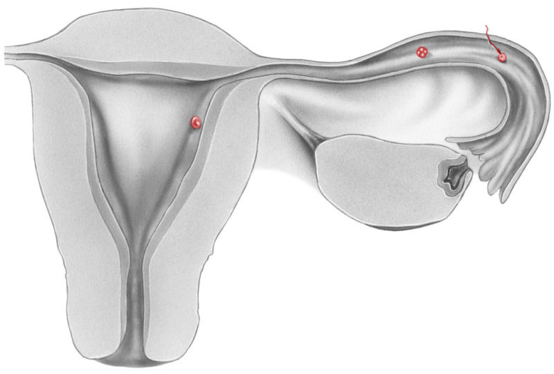 UNIDAD DE ABORTO DE REPETICIÓN y FALLO DE IMPLANTACIÓN