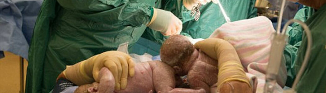 Un mujer australiana da a luz extrayéndose ella misma a sus gemelas