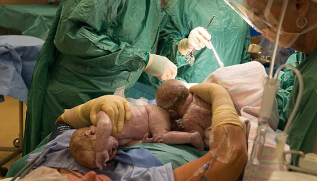 Un mujer australiana da a luz extrayéndose ella misma a sus gemelas