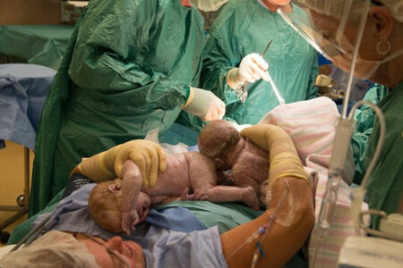 Un mujer australiana da a luz extrayéndose ella misma a sus gemelas