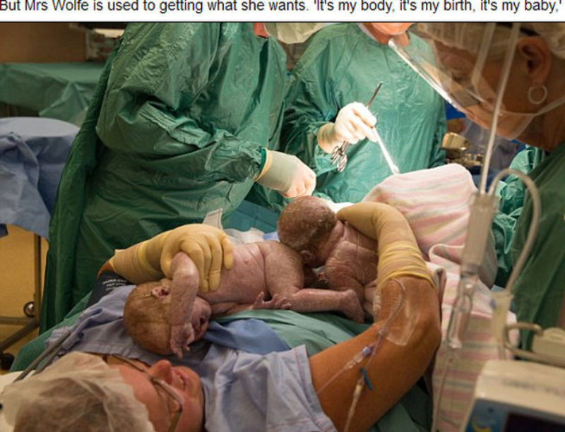 Un mujer australiana da a luz extrayéndose ella misma a sus gemelas