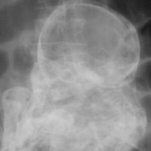 Una mujer de 84 años de edad lleva en su vientre un feto hace más de 40 años