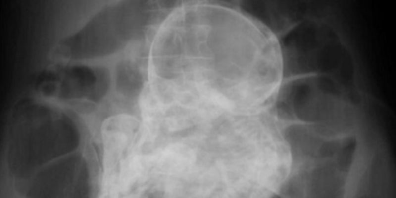 Una mujer de 84 años de edad lleva en su vientre un feto hace más de 40 años