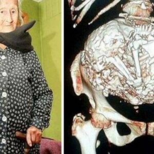 Una mujer de 91 años podría haber llevado un feto momificado durante 50 años en su interior