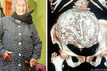 Una mujer de 91 años podría haber llevado un feto momificado durante 50 años en su interior