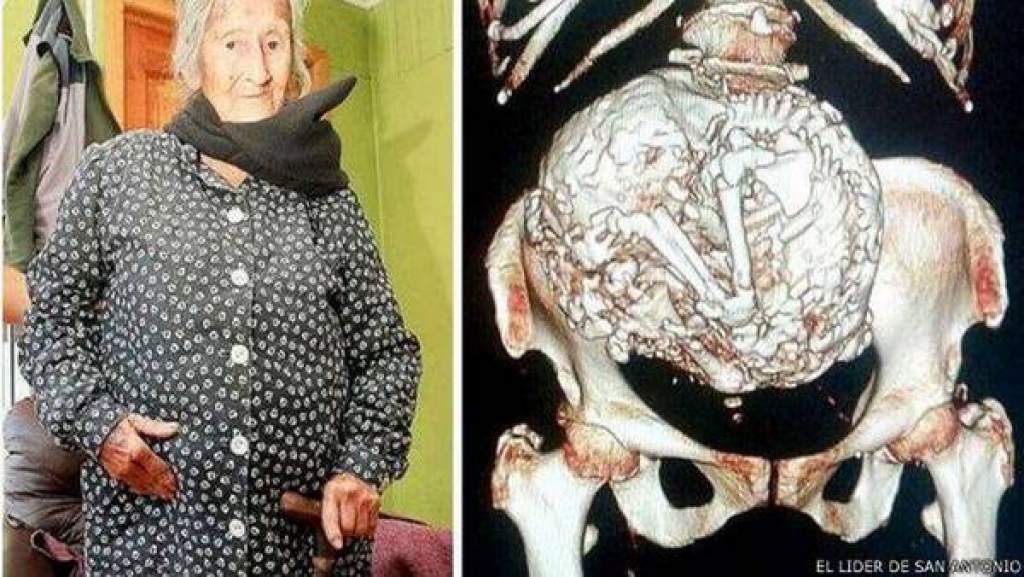 Una mujer de 91 años podría haber llevado un feto momificado durante 50 años en su interior