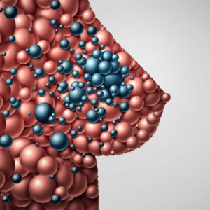 Una nueva prueba permitirá a la mayoría de las pacientes con cáncer de mama evitar la quimioterapia