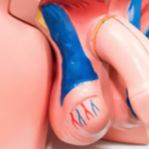 Varicocele e infertilidad masculina