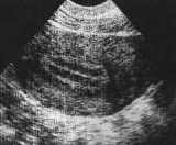 Endometrio de 5 mm este año