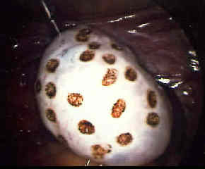 ¿Diatermia contra la esterilidad?