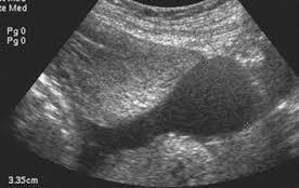 ¿Se puede ver obstrucción de las trompas mediante ecografía vaginal?