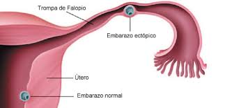 ¿Cuánto tengo que esperar para saber si tengo un embarazo ectópico?