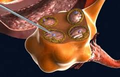 ¿Mi sobrepeso puede influir en que tras la extracción folicular éstos están vacíos?