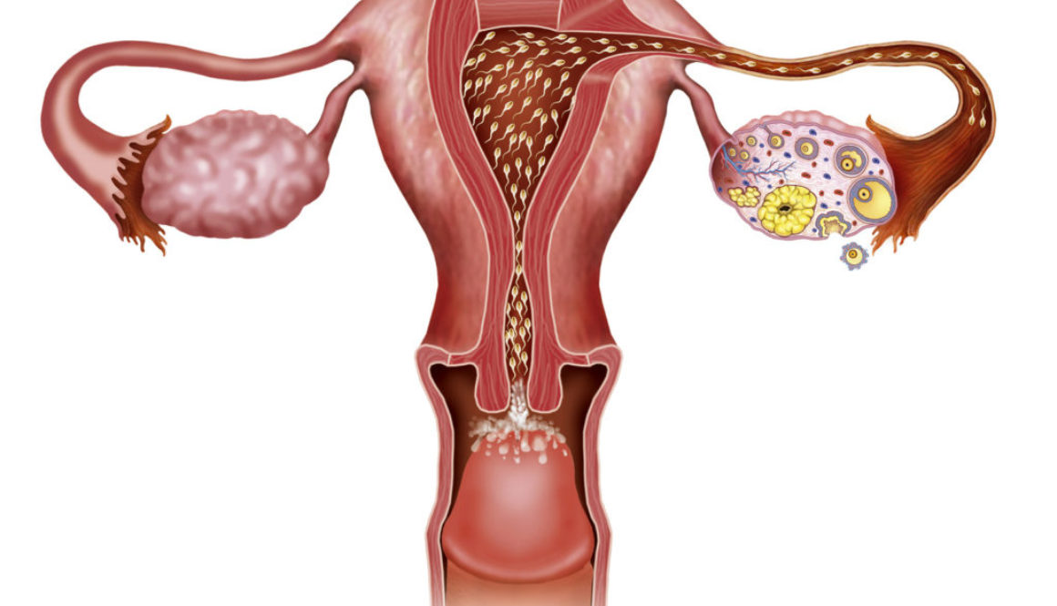 ¿Me están afectando los quistes al endométrio?