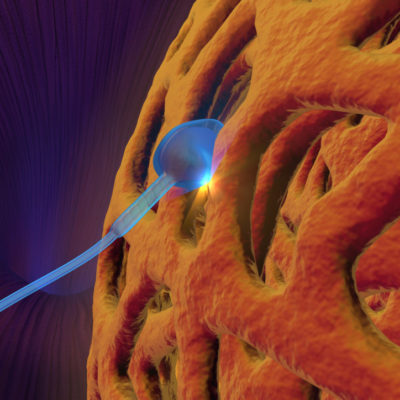 Aspiración Microquirúrgica del Esperma del Epidídimo (MESA)