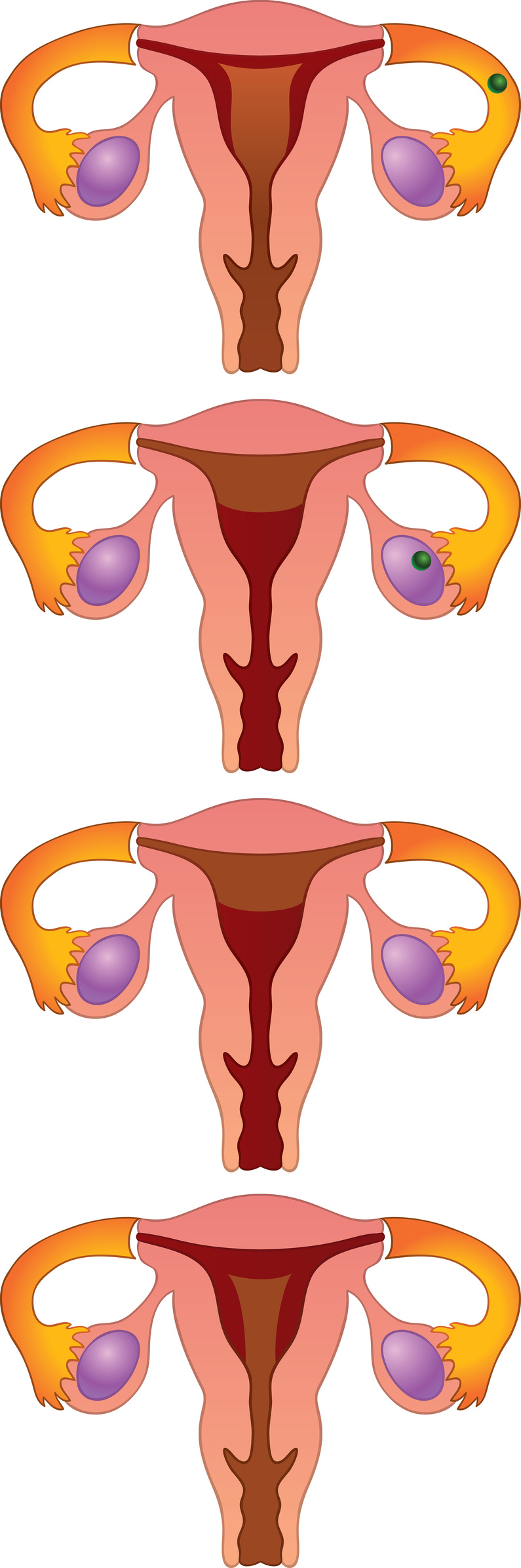 ¿Este tipo de quiste se elimina con la menstruación?