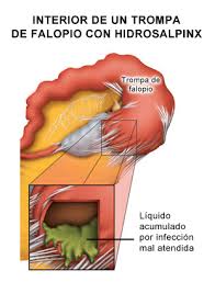 ¿Es necesario recurrir a la extirpación de una trompa a causa de un hidrosálpinx?