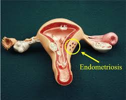 ¿Cuál es la diferencia entre endometriosis y Síndrome de Asherman?