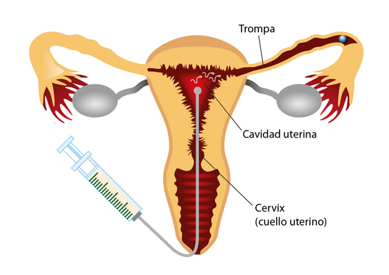 ¿por qué no hacer una FIV directamente?