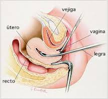 Posibles secuelas de un legrado?