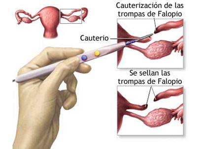 Puedo volver a tener hijos.....