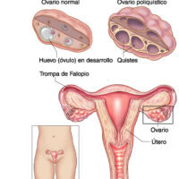 ovarios poliquisticos