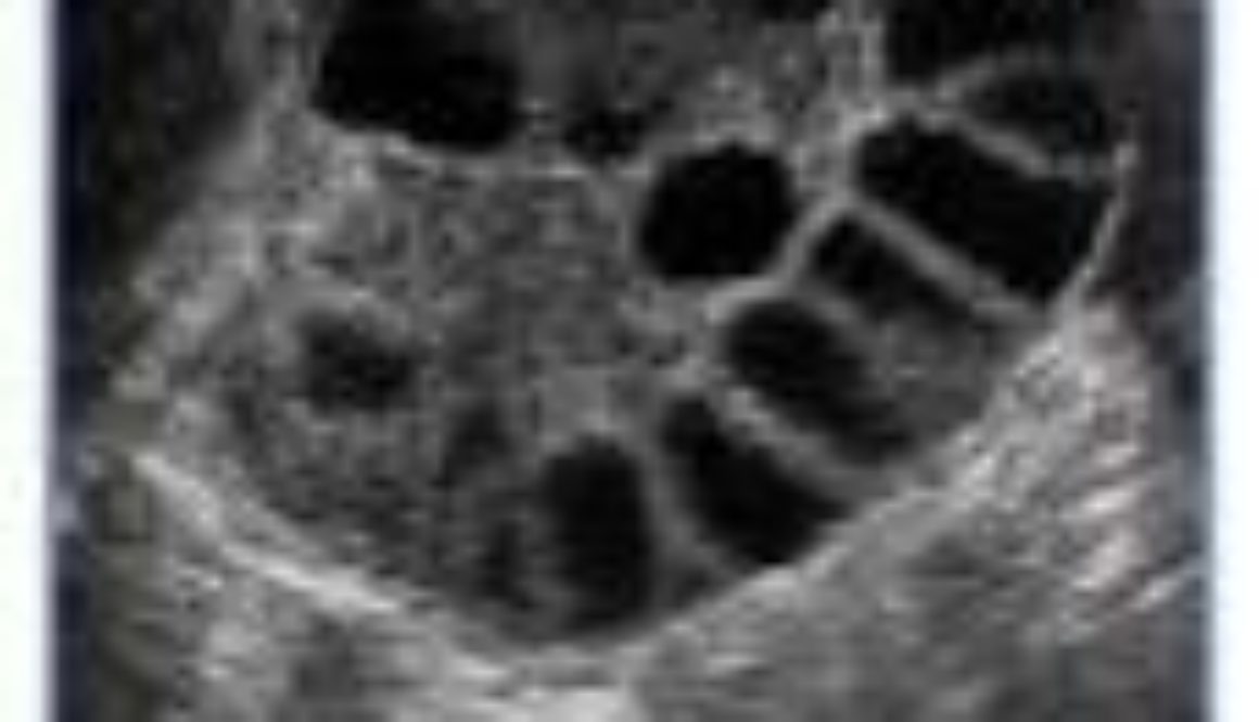 Tengo síndrome de ovario poliquístico