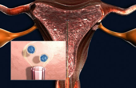 transferencia dolorosa