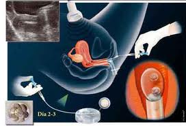 Fecundación in vitro