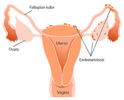 ¿Puedo quedarme embarazada ahora que me han tratado la endometriosis con laparoscopia?