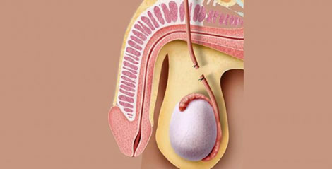 ¿HAY ALGUNA POSIBILIDAD DE TENER HIJOS DESPUÉS DE UNA VASECTOMÍA?